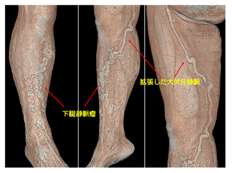 表在性血栓静脈炎の治療法は何ですか?